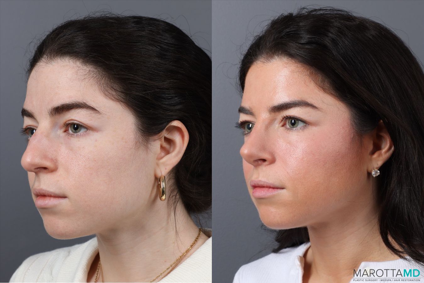 Before and after Rhinoplasty case 43707 - Angle 3