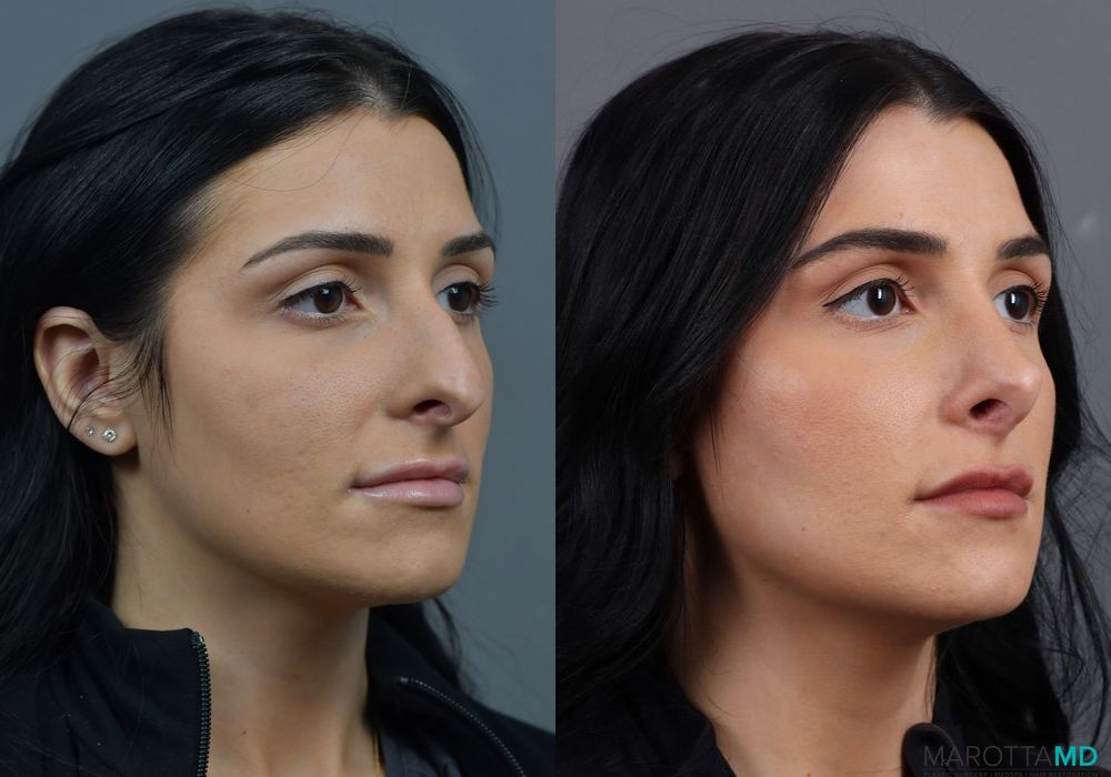 Rhinoplasty - Thumbnail 2