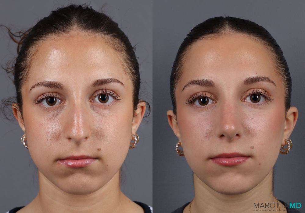 Before and after Rhinoplasty case 7139