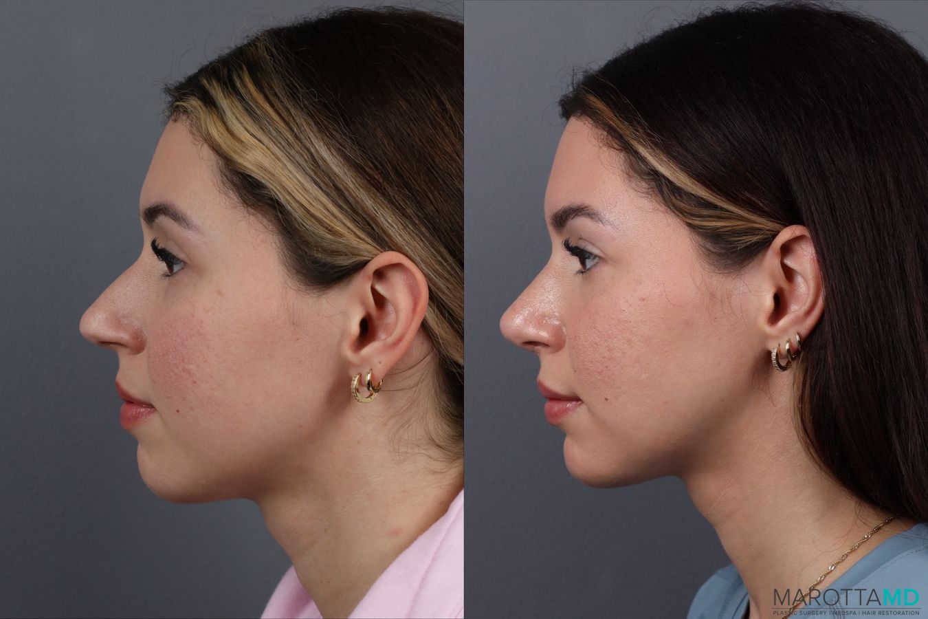 Before and after Rhinoplasty case 17177 - Angle 5