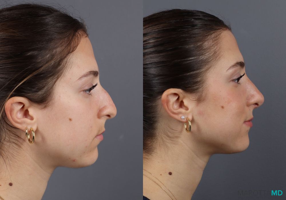 Before and after Rhinoplasty case 7138 - Angle 5
