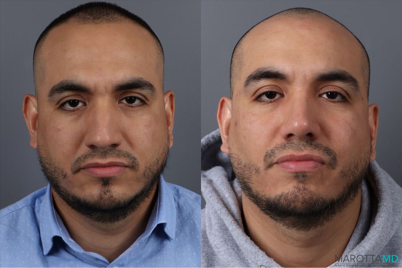 Before and after Rhinoplasty case 21670