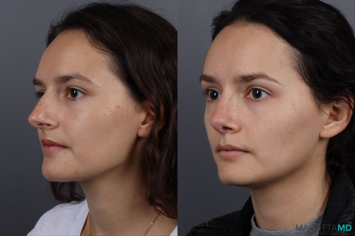 Before and after Rhinoplasty case 13237 - Angle 4