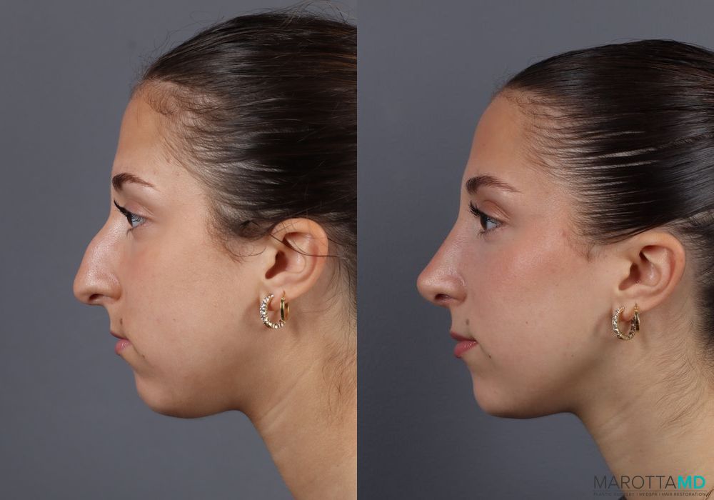Before and after Rhinoplasty case 7139 - Angle 2