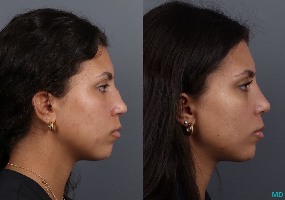 Rhinoplasty - Case 606