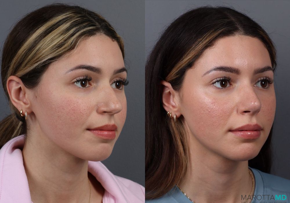 Rhinoplasty - Thumbnail 2