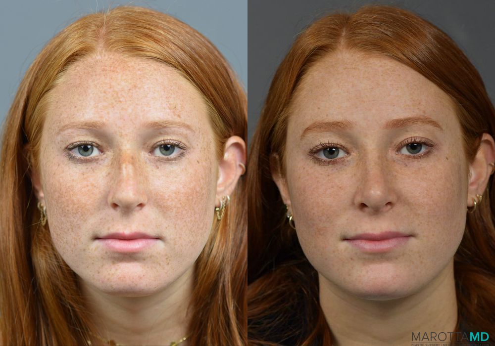 Rhinoplasty - Case 266