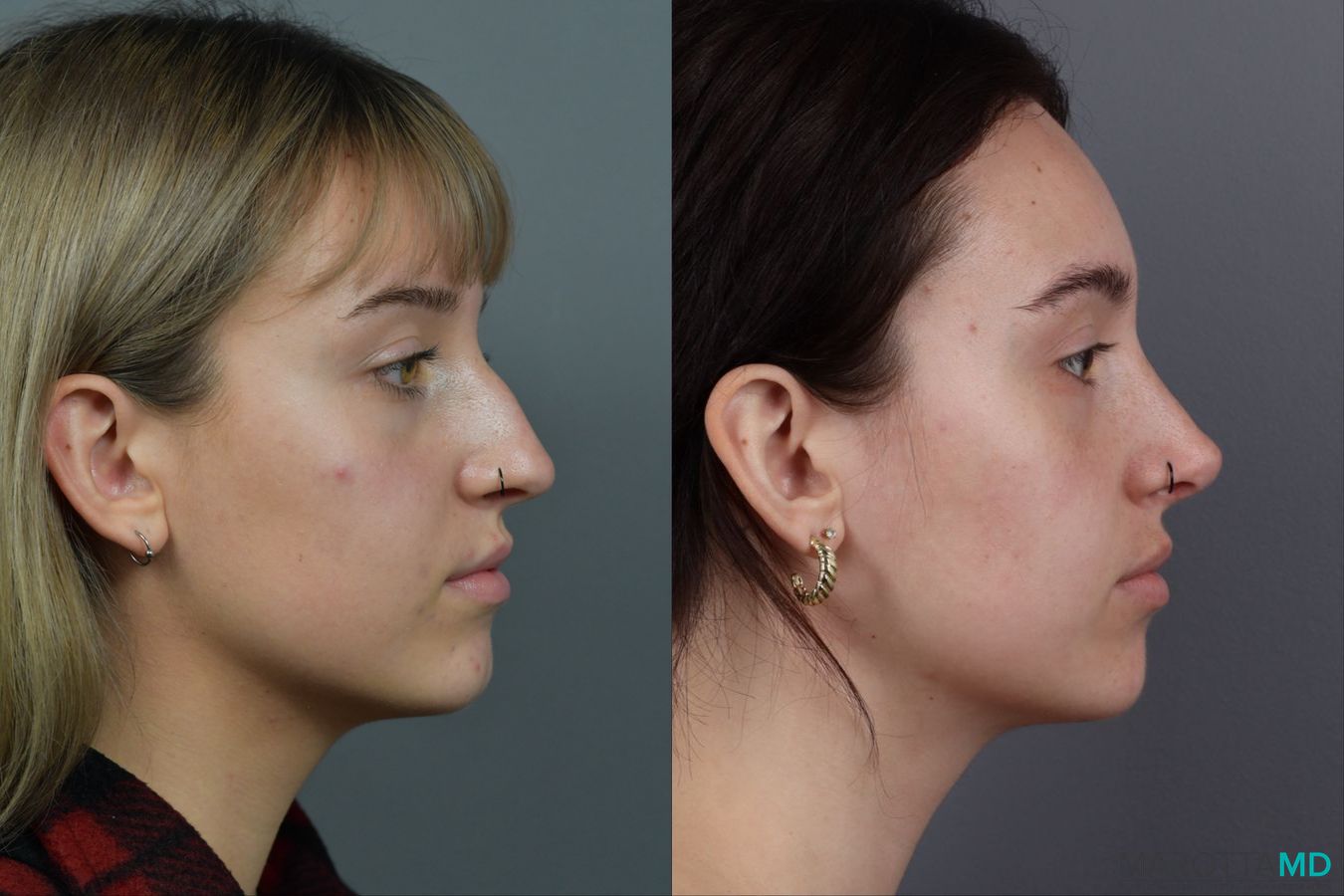 Before and after Rhinoplasty case 12317 - Angle 3