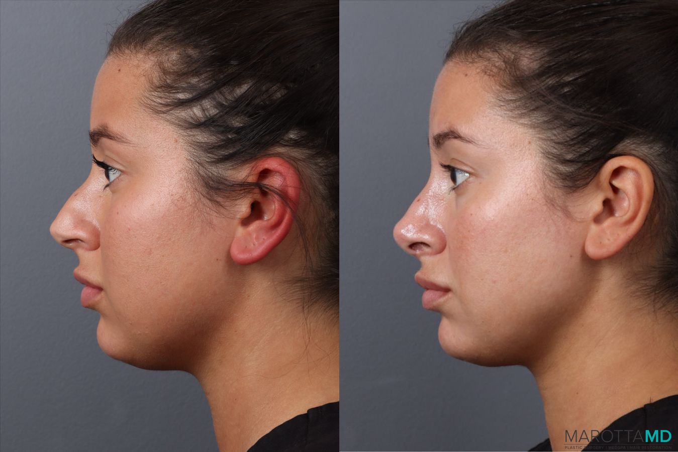 Before and after Rhinoplasty case 49458 - Angle 5