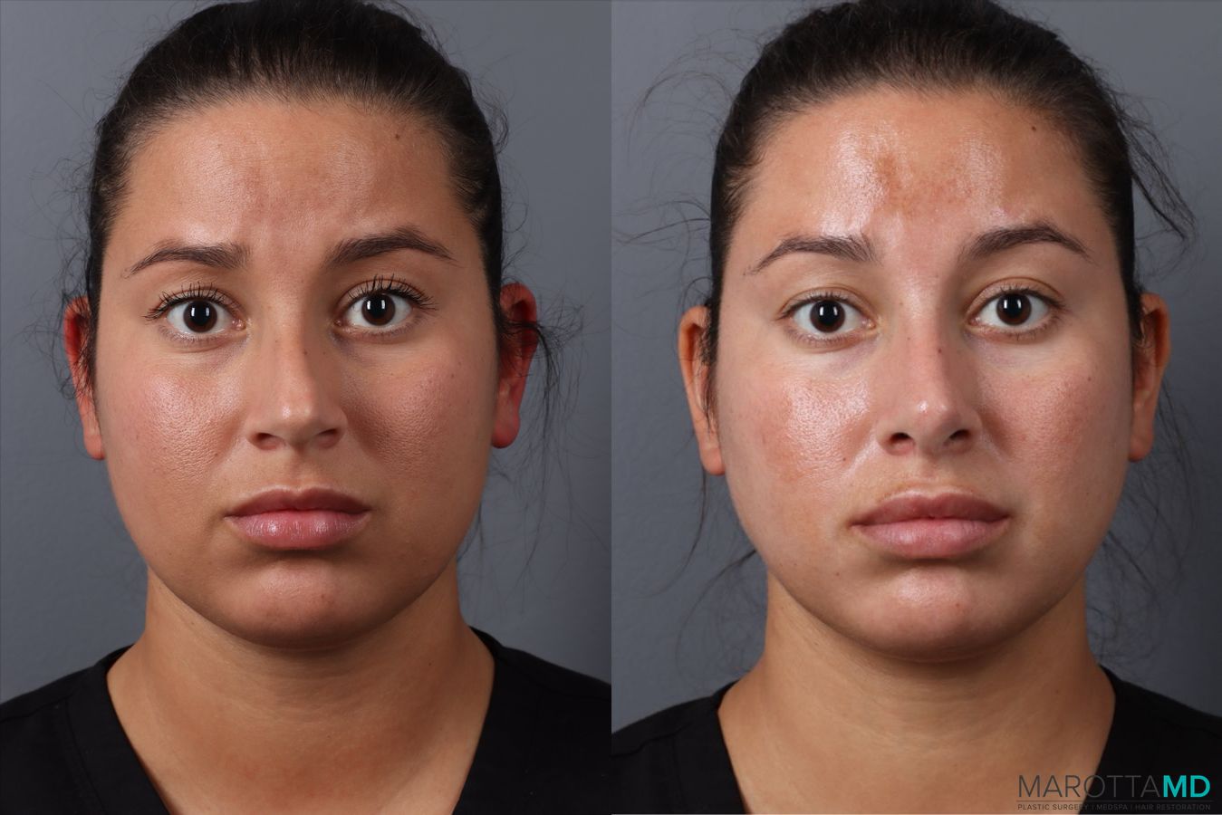 Before and after Rhinoplasty case 49458