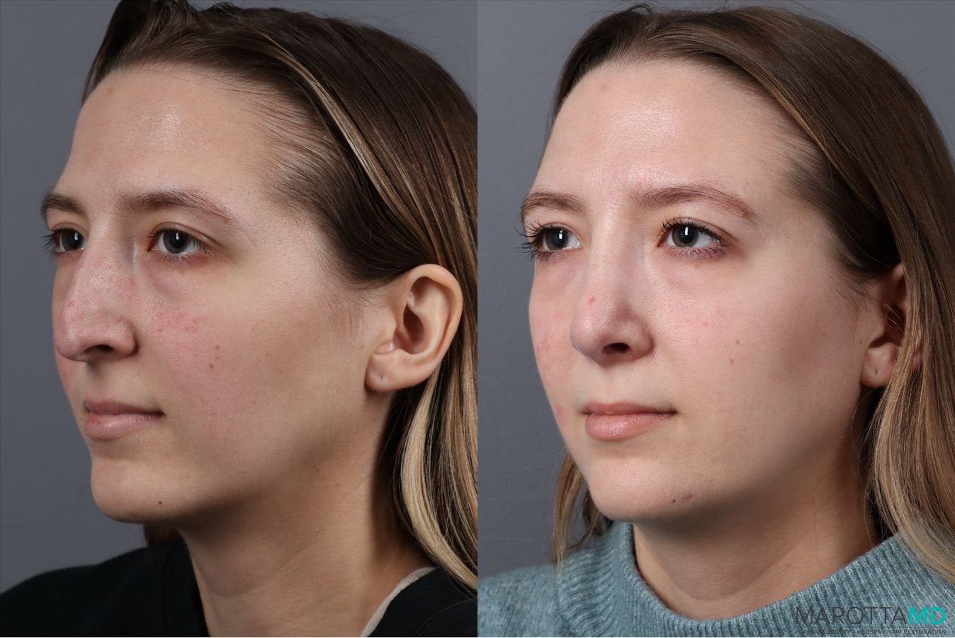 Before and after Rhinoplasty case 41762 - Angle 3