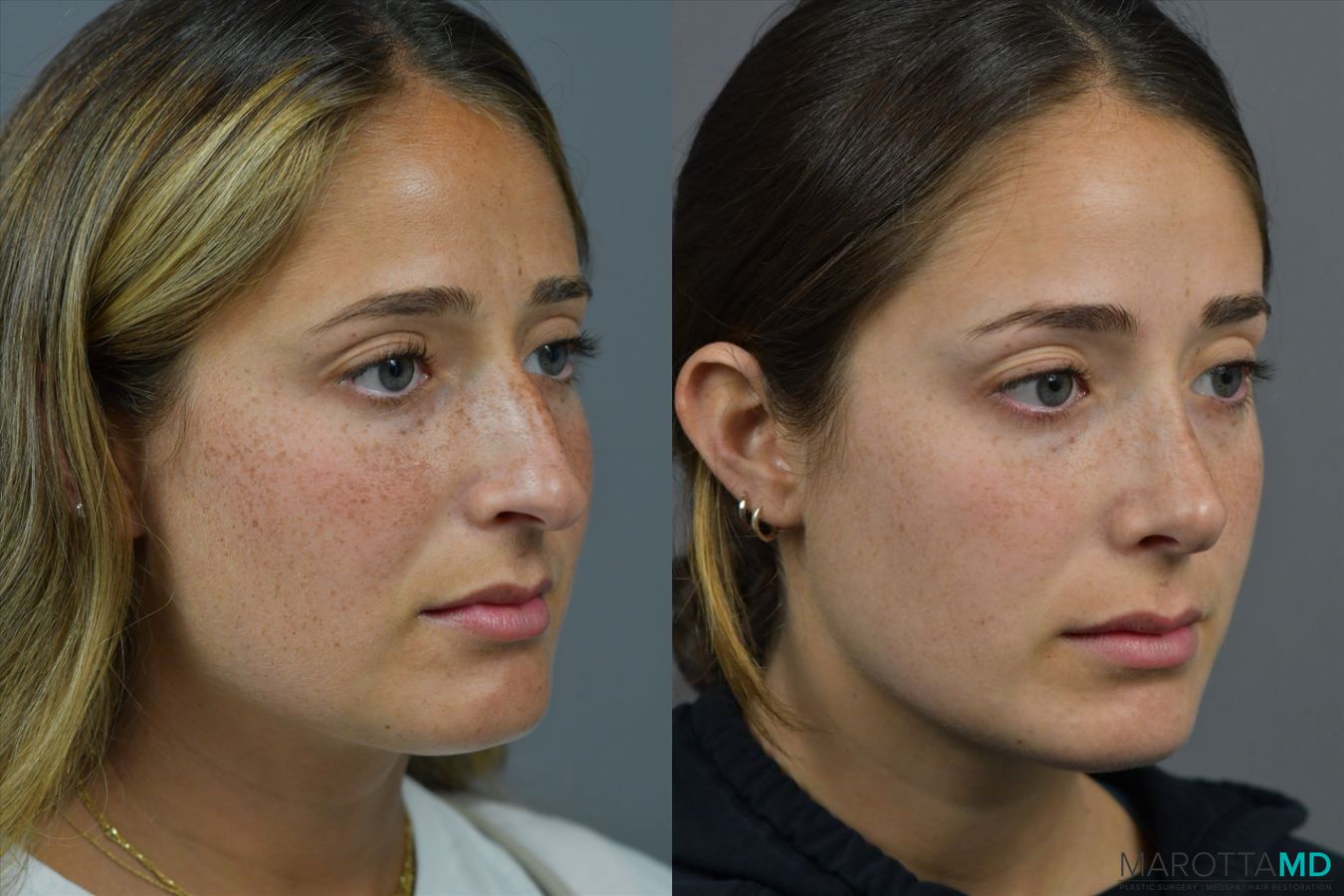 Before and after Rhinoplasty case 41923 - Angle 4