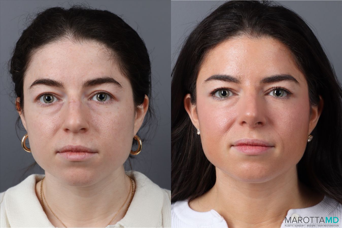 Before and after Rhinoplasty case 43707