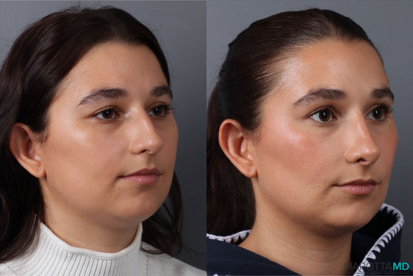 Before and after Rhinoplasty case 43704 - Angle 2