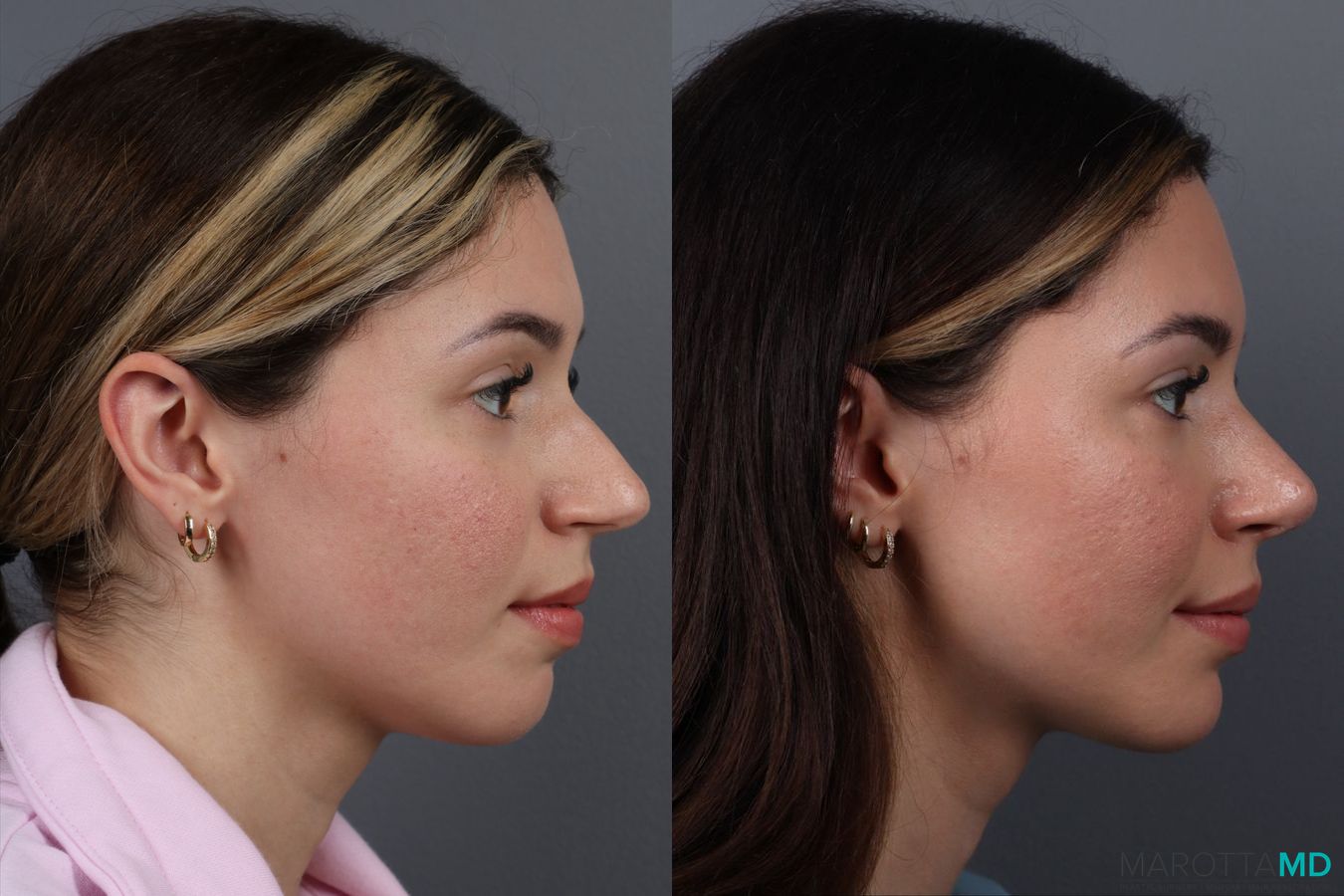Before and after Rhinoplasty case 17177 - Angle 3