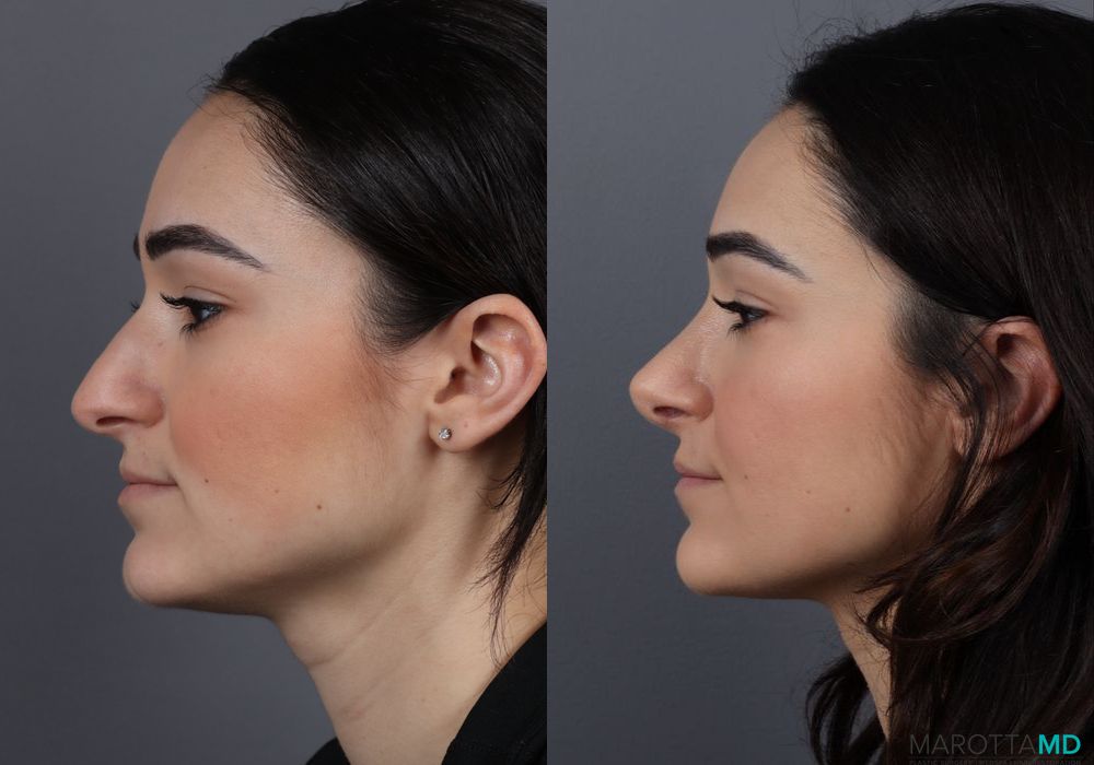 Rhinoplasty - Thumbnail 5