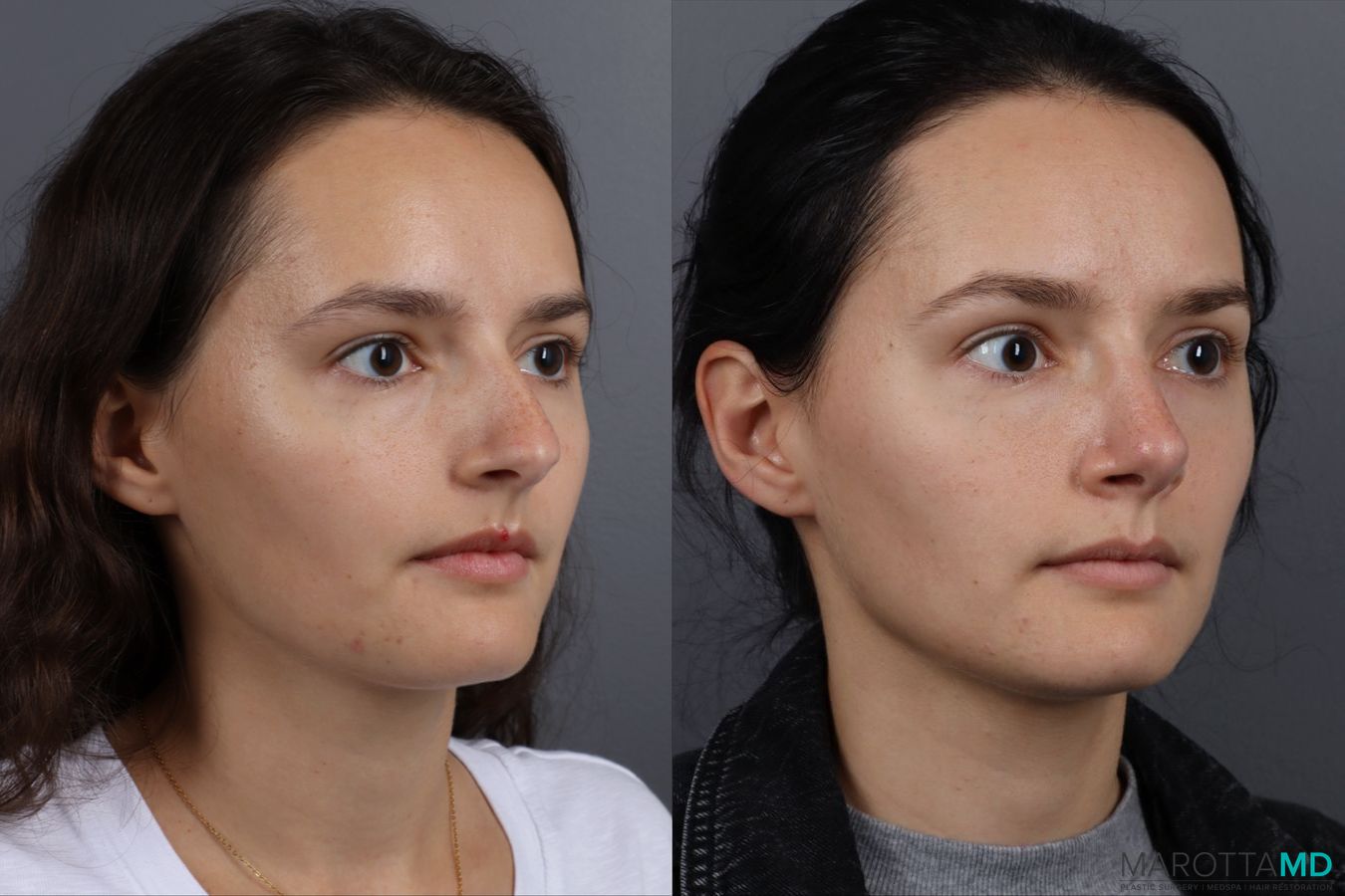 Before and after Rhinoplasty case 13237 - Angle 2