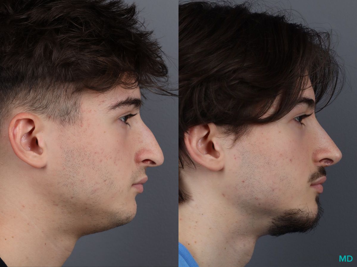 Before and after Rhinoplasty case 12828 - Angle 3
