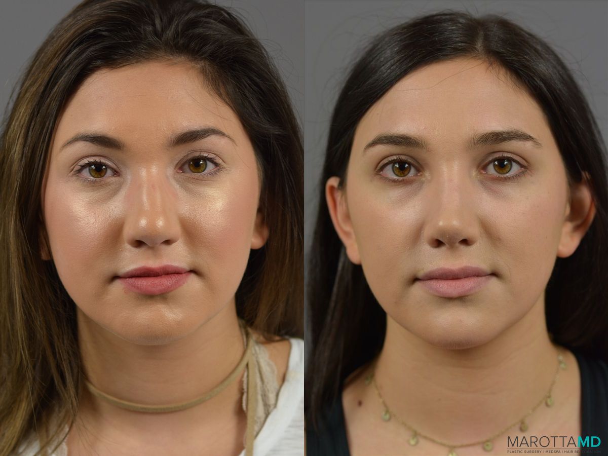 Before and after Rhinoplasty case 18387