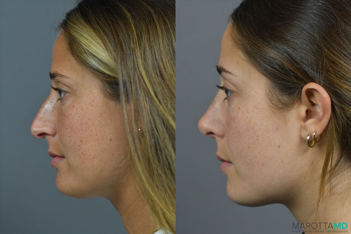 Before and after Rhinoplasty case 41923 - Angle 3
