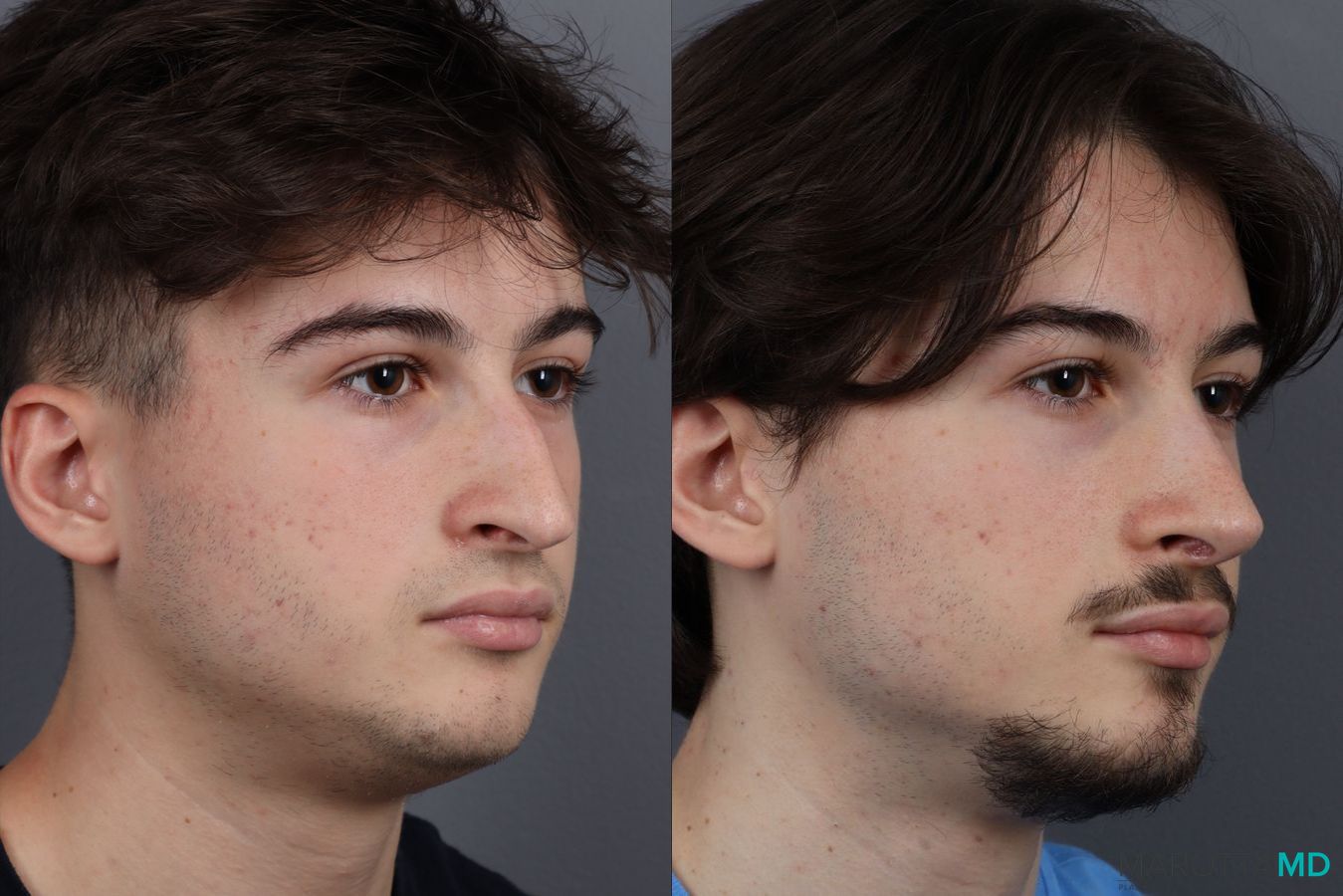 Before and after Rhinoplasty case 12828 - Angle 2