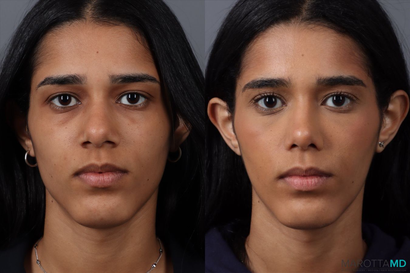 Before and after Rhinoplasty case 49459