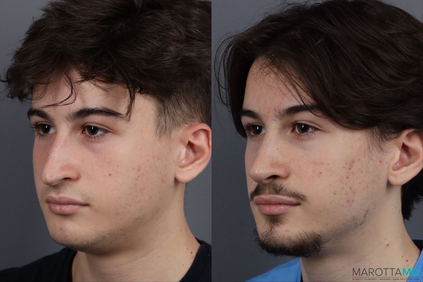 Before and after Rhinoplasty case 12828 - Angle 4