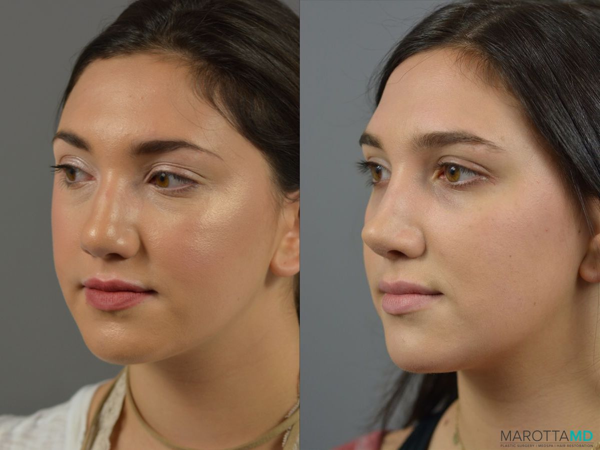 Before and after Rhinoplasty case 18387 - Angle 3