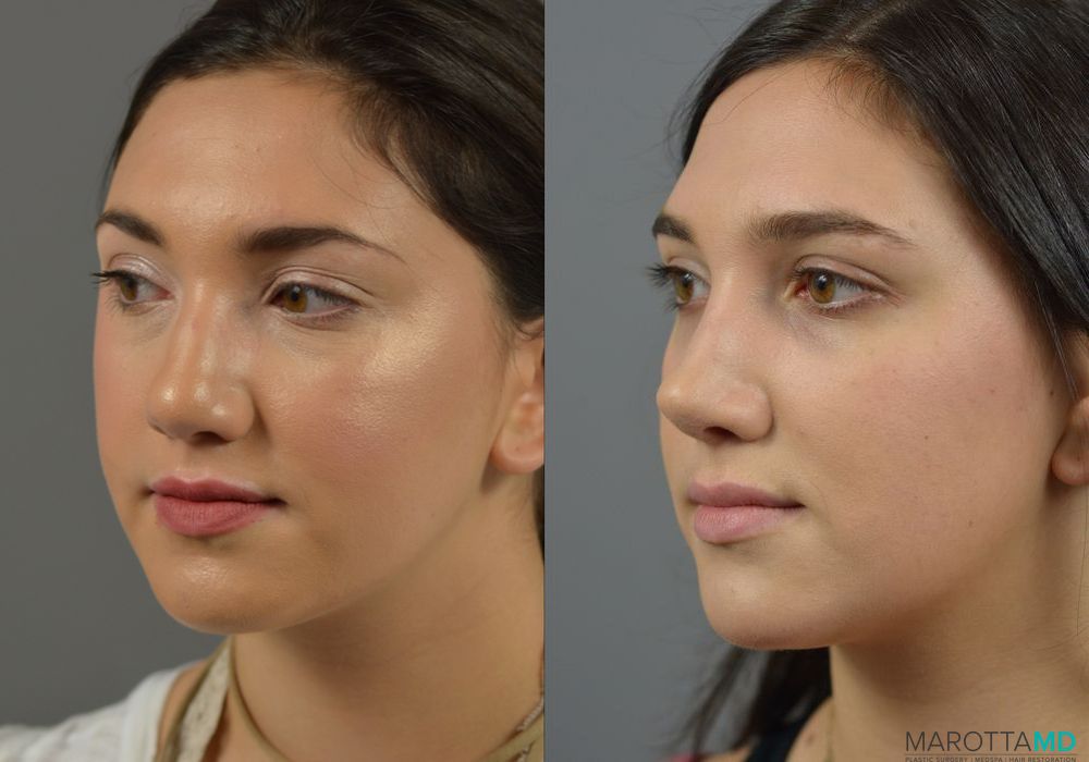 Rhinoplasty - Thumbnail 3