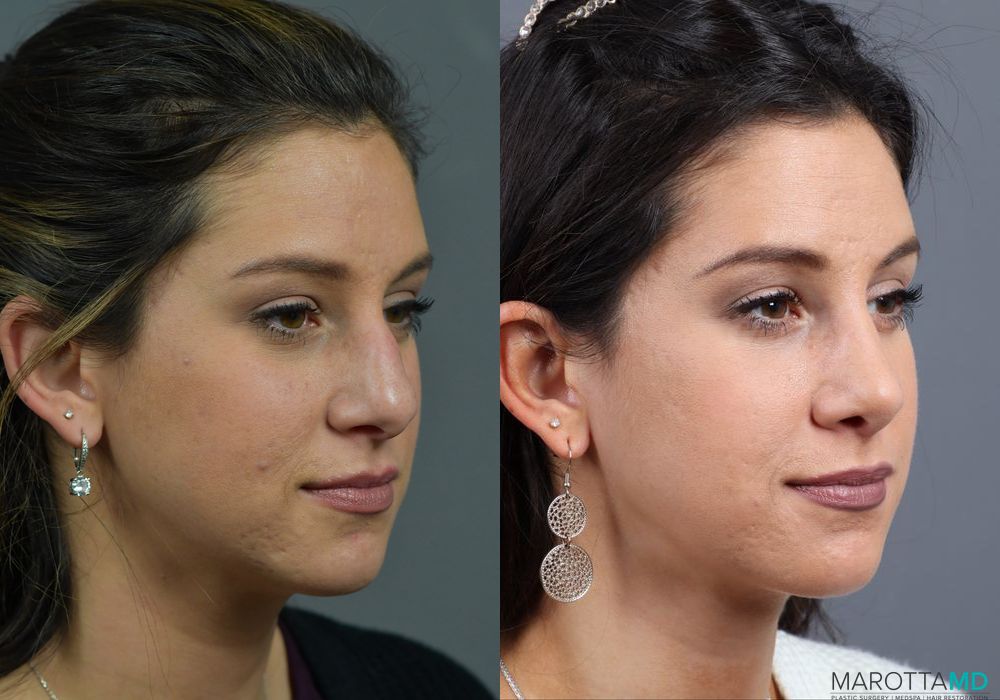 Rhinoplasty - Thumbnail 2