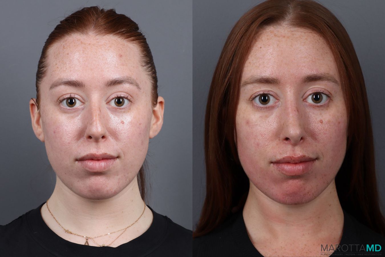 Before and after Rhinoplasty case 19923