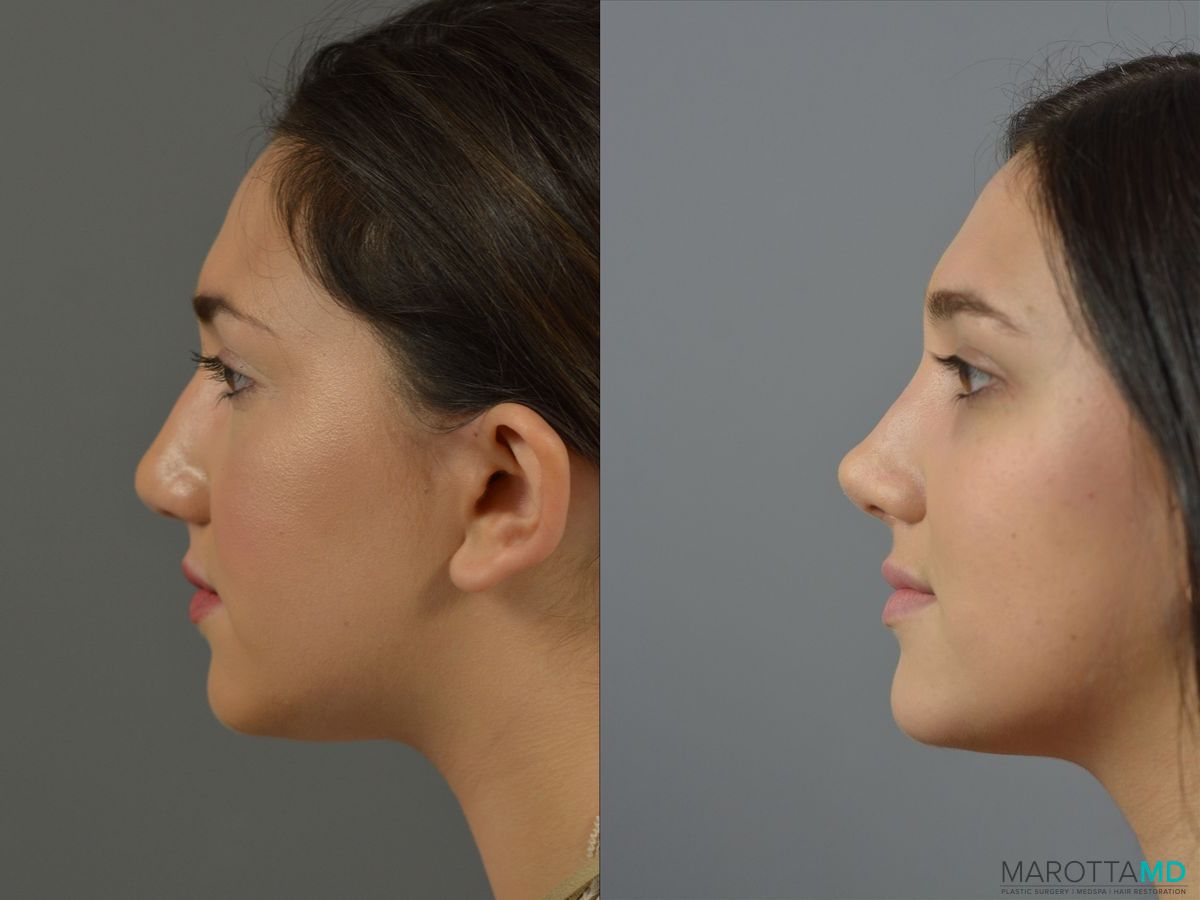 Before and after Rhinoplasty case 18387 - Angle 2