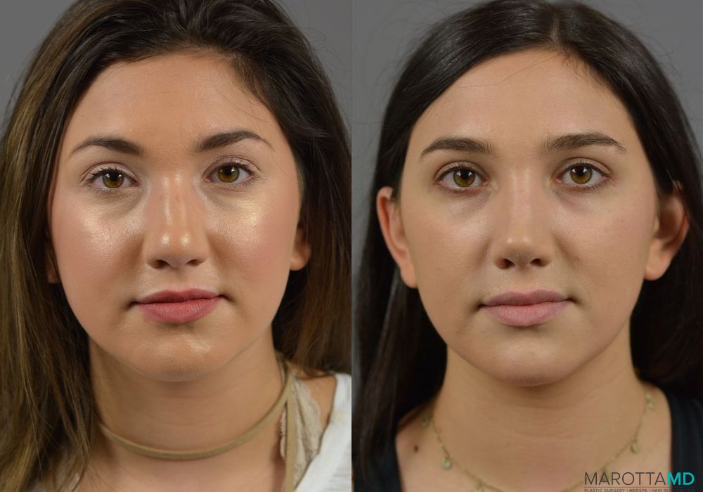 Rhinoplasty - Case 272