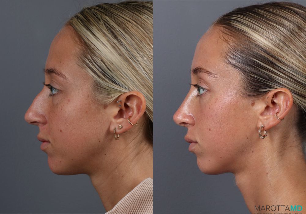 Rhinoplasty - Thumbnail 5