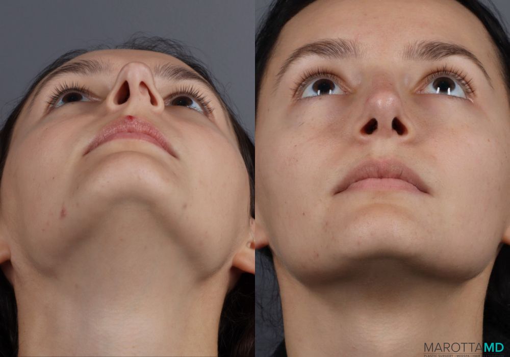 Rhinoplasty - Thumbnail 3