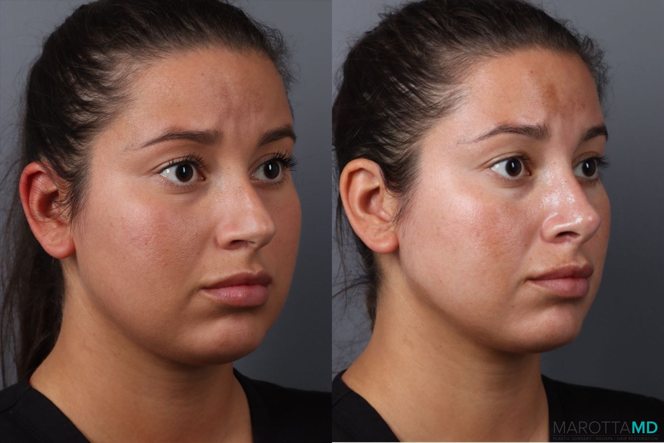 Before and after Rhinoplasty case 49458 - Angle 2