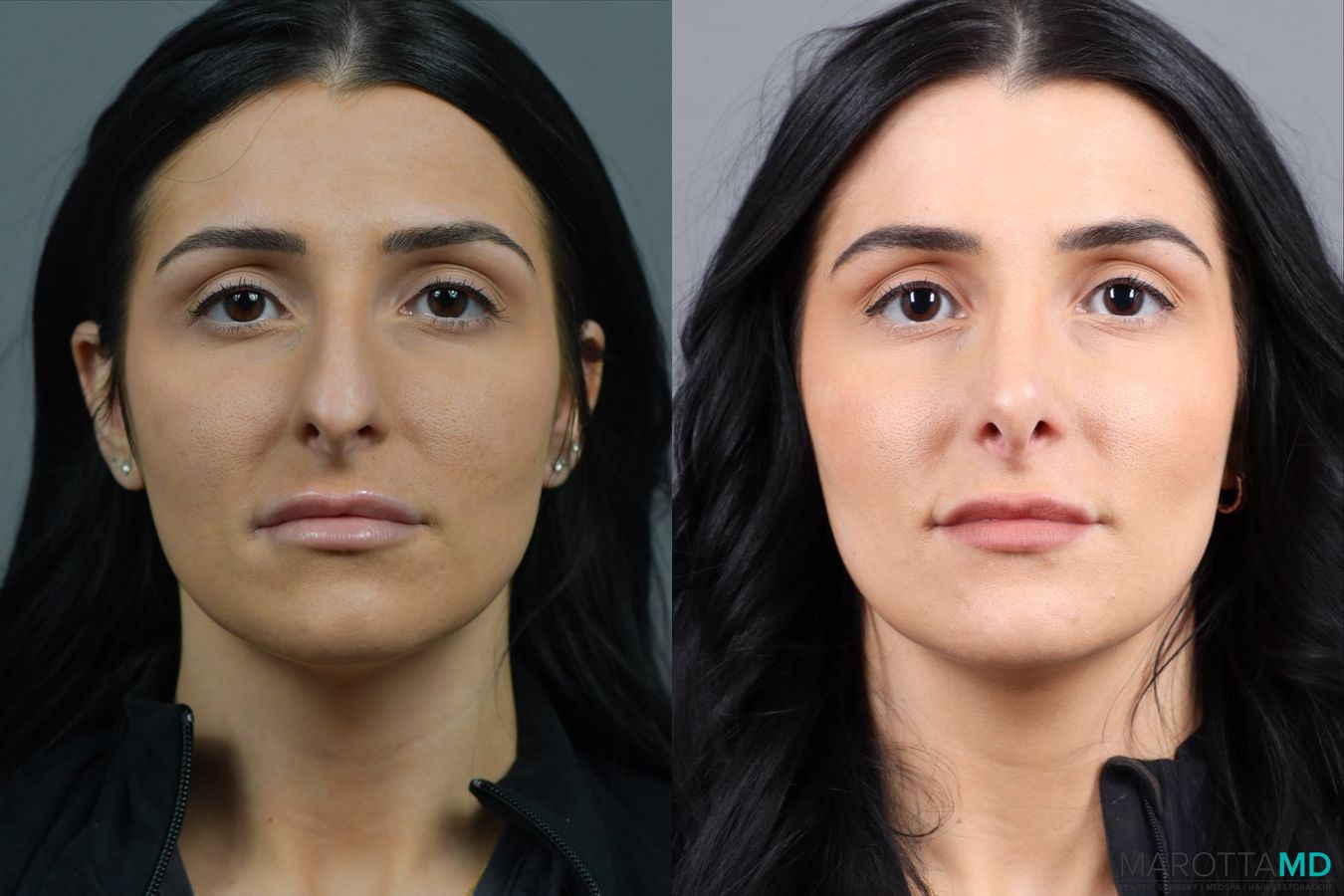Before and after Rhinoplasty case 17406