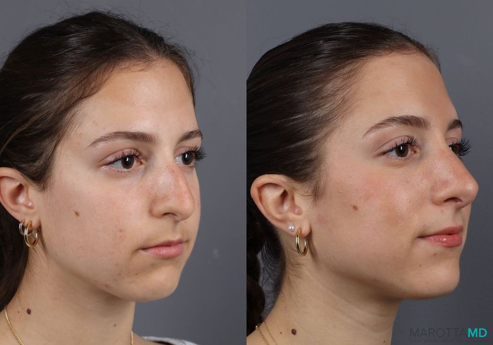 Before and after Rhinoplasty case 7138 - Angle 4
