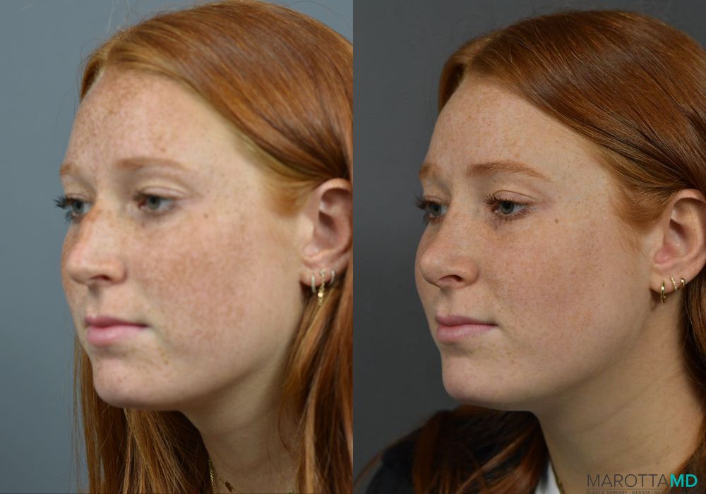 Rhinoplasty - Thumbnail 4