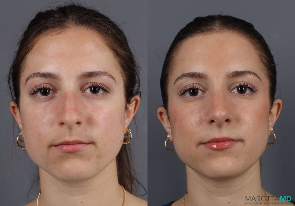 Before and after Rhinoplasty case 7138