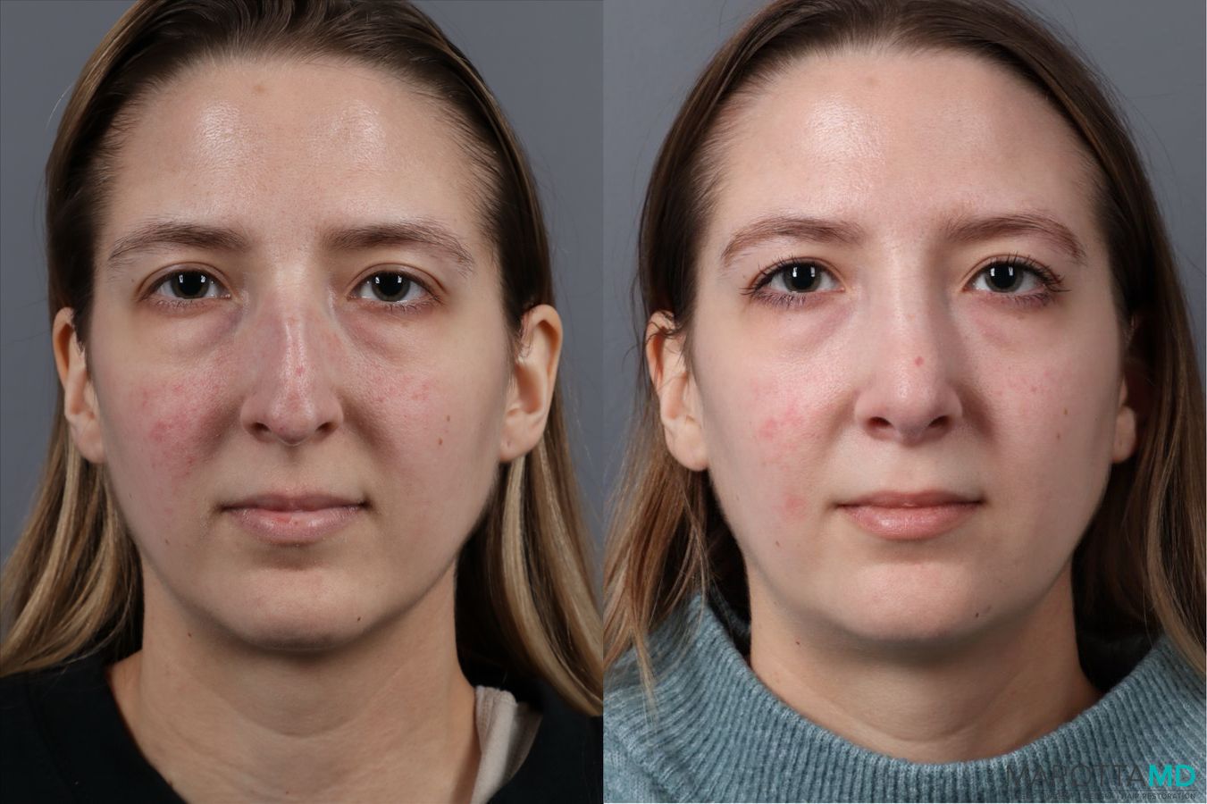 Before and after Rhinoplasty case 41762