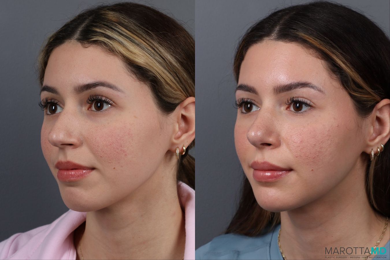 Before and after Rhinoplasty case 17177 - Angle 4