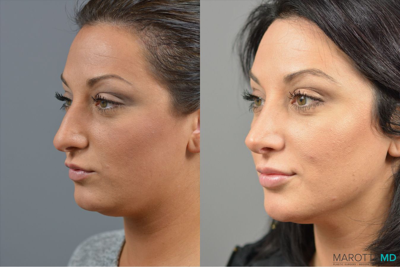 Before and after Rhinoplasty case 41921 - Angle 4