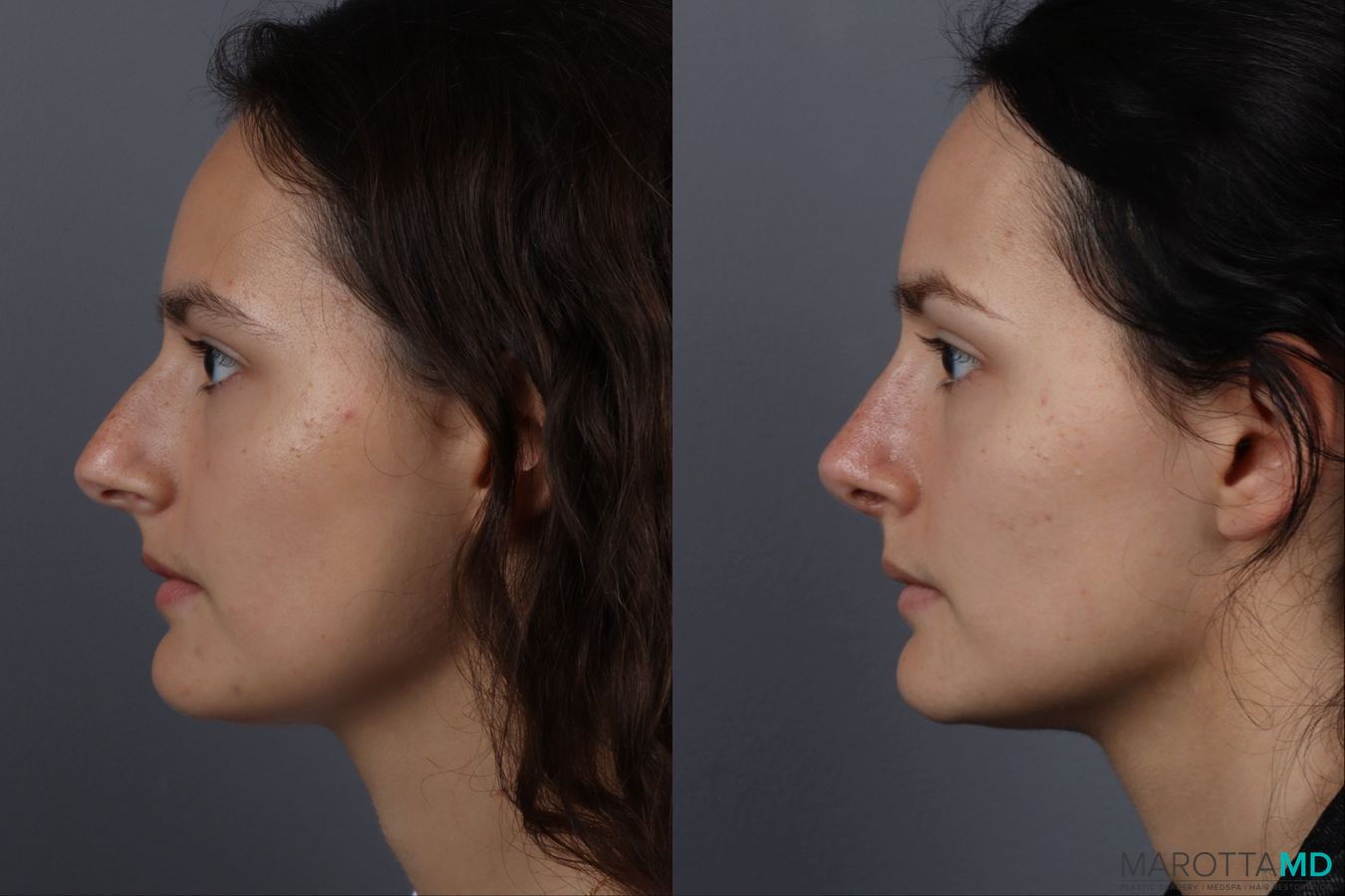 Before and after Rhinoplasty case 13237 - Angle 5