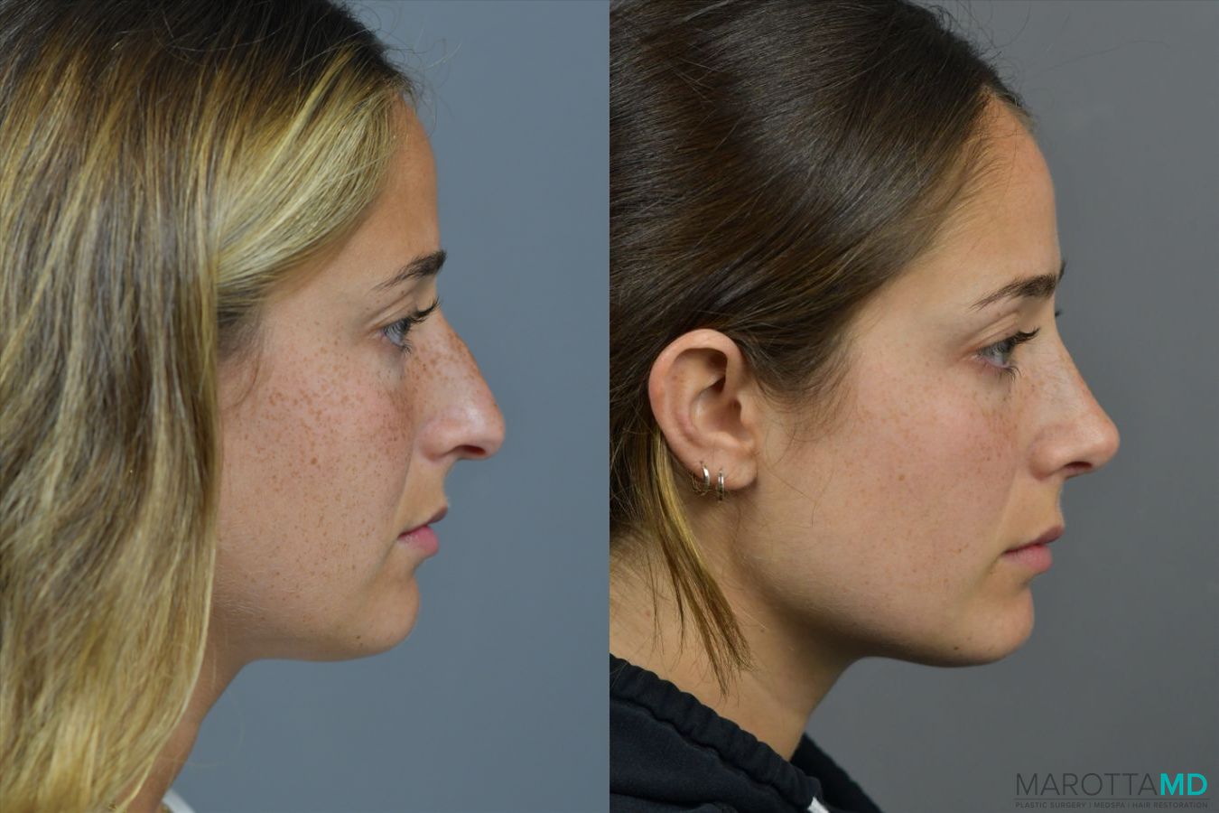 Before and after Rhinoplasty case 41923 - Angle 5