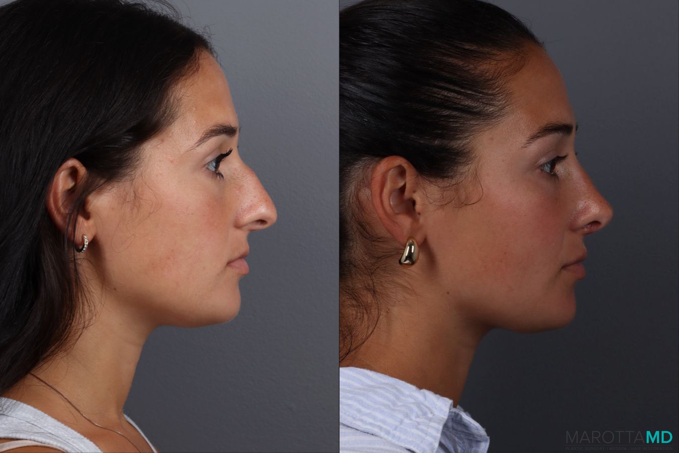 Before and after Rhinoplasty case 19687 - Angle 3