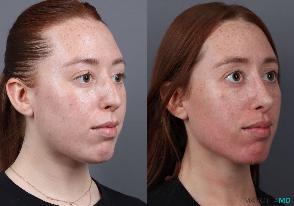Rhinoplasty - Thumbnail 2