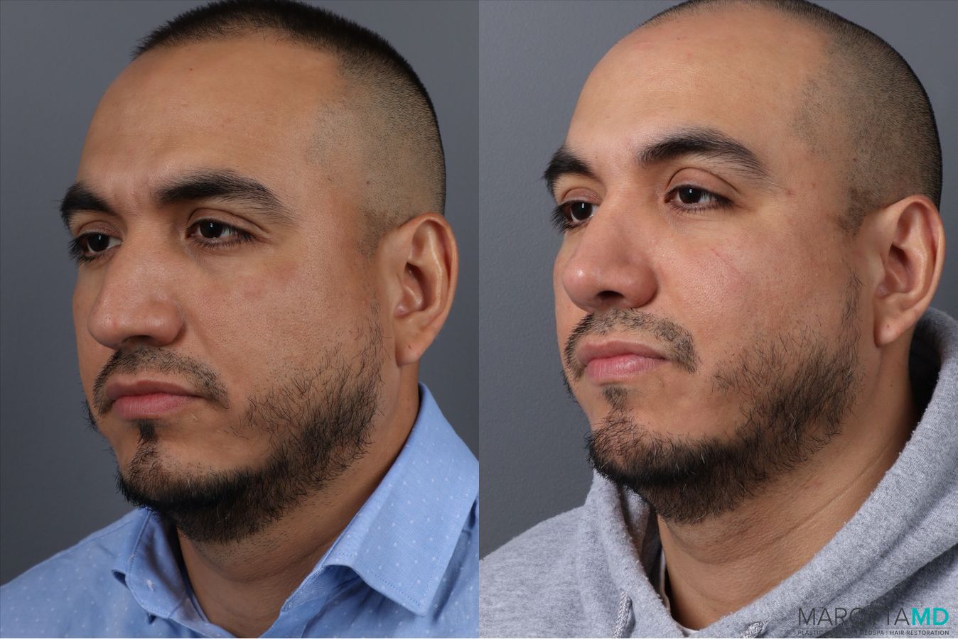 Before and after Rhinoplasty case 21670 - Angle 3