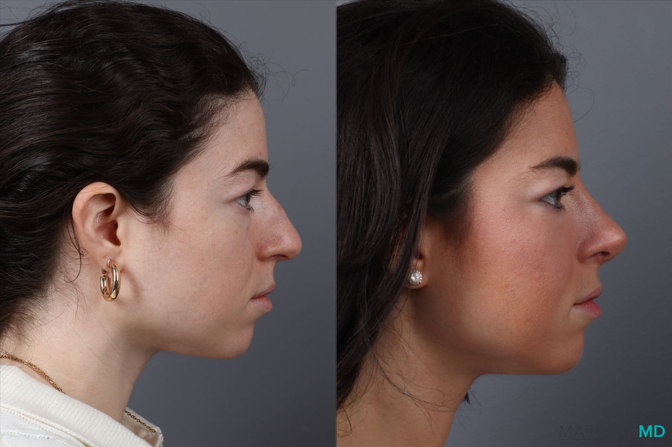 Before and after Rhinoplasty case 43707 - Angle 2