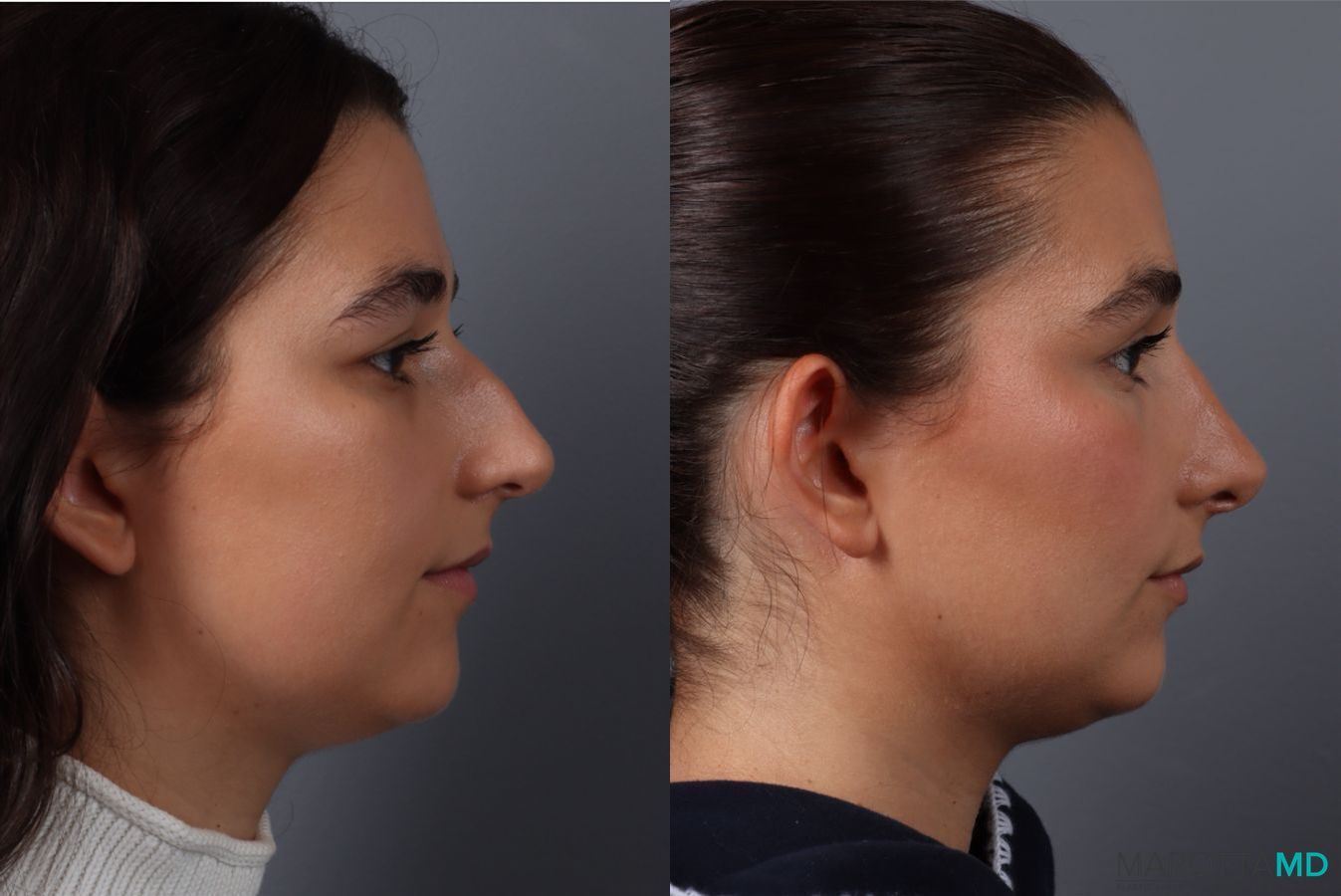 Before and after Rhinoplasty case 43704 - Angle 3